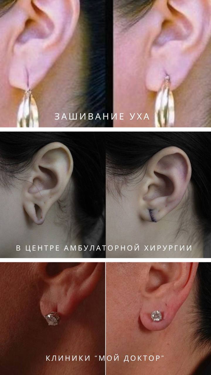 ЗАШИВАНИЕ МОЧКИ УХА | ЦЕНТР АМБУЛАТОРНОЙ ХИРУРГИИ В АРМАВИРЕ