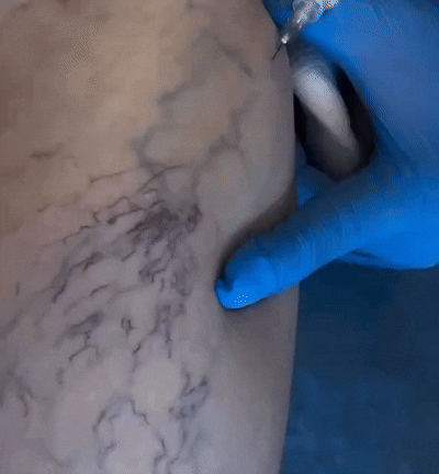 СКЛЕРОТЕРАПИЯ | ФЛЕБОЛОГ В АРМАВИРЕ