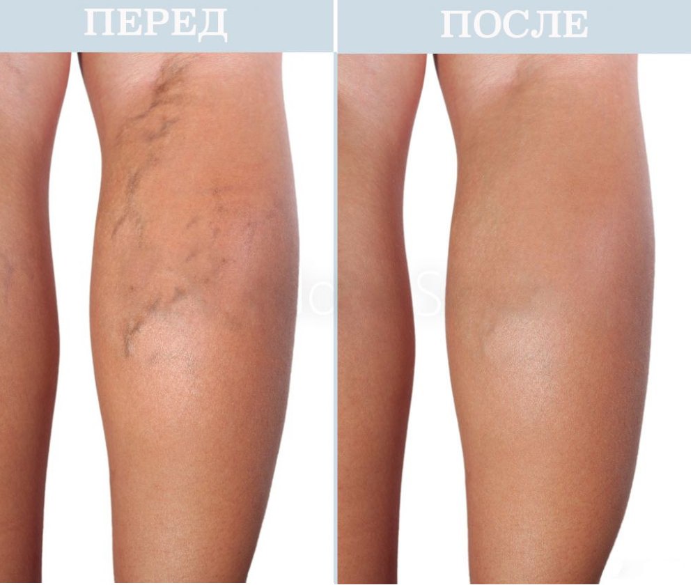 СКЛЕРОТЕРАПИЯ | ФЛЕБОЛОГ В АРМАВИРЕ