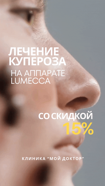 Лечение купероза и сосудистых звёздочек на лице - с дополнительной скидкой! 