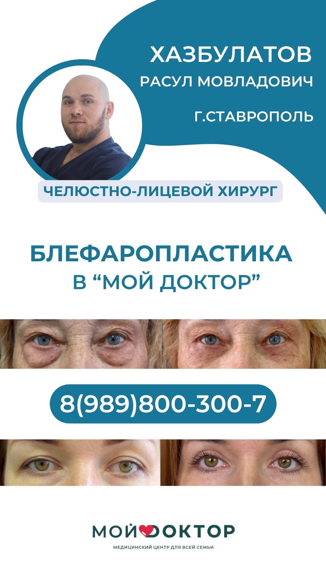 ПЛАСТИКА ВЕК В АРМАВИРЕ | БЛЕФАРОПЛАСТИКА В "МОЙ ДОКТОР"