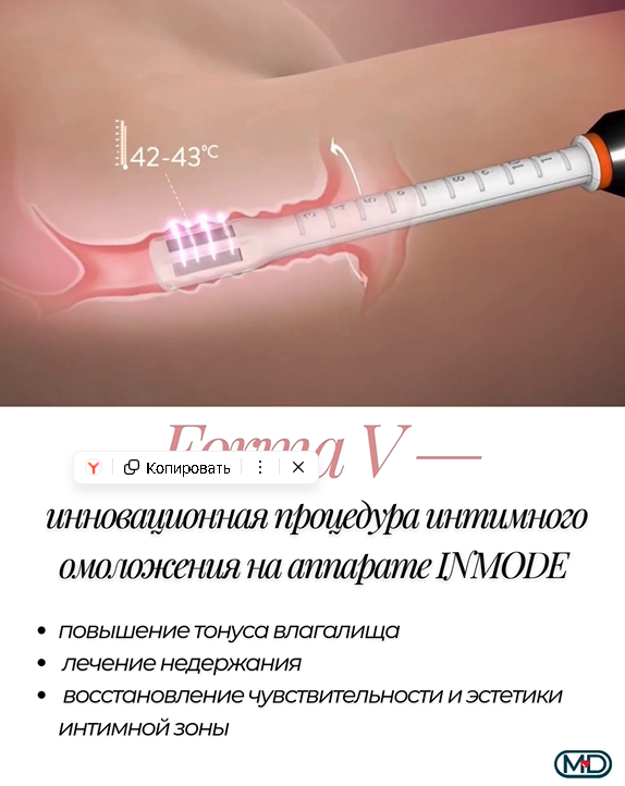 Лечение недержания у женщин — Forma V на аппарате InMode