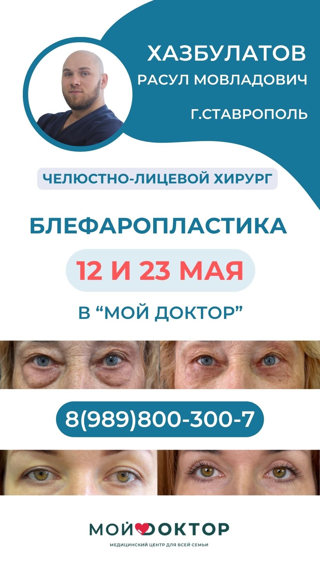 ПЛАСТИКА ВЕК В АРМАВИРЕ | БЛЕФАРОПЛАСТИКА В "МОЙ ДОКТОР"